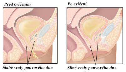 Kegelove cviky výsledky